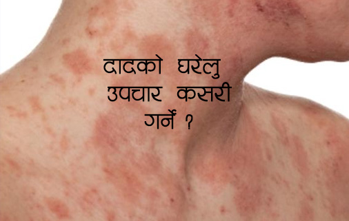दादले हैरान बनाएको छ ? यो हो घरेलु उपचार