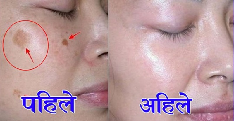 छालामा दाद देखियो ? उपचार यसरी गर्नुहोस्